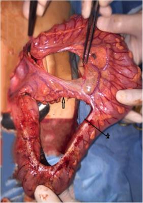 The Technique of Mobilization of the Colon for Pull-Through Procedure in Hirschsprung’s Disease